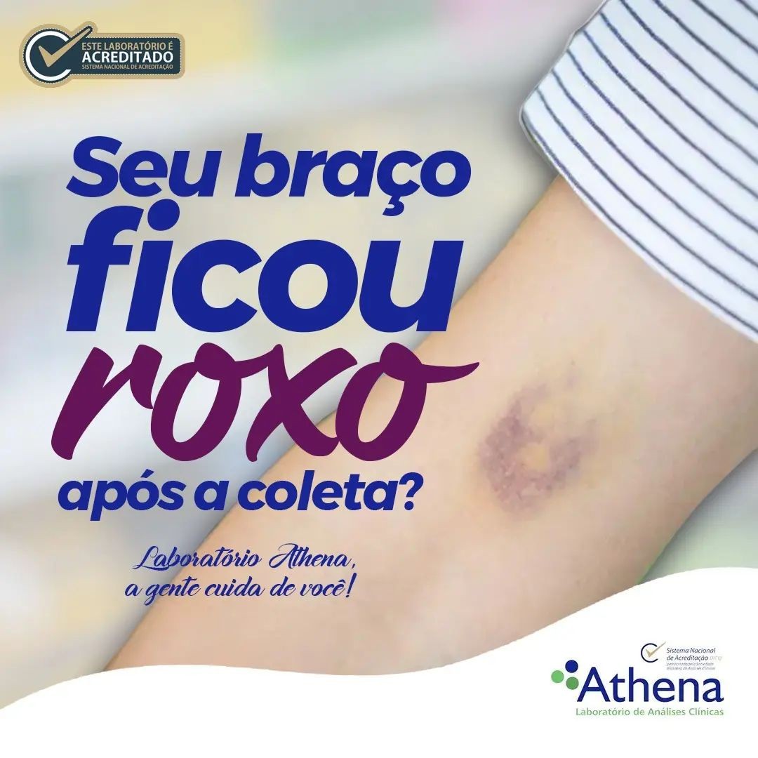 Após a coleta de sangue, seu braço ficou roxo?